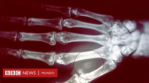 Cómo funcionan los microchips que se implantan bajo la piel y